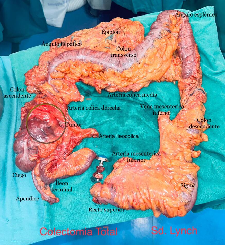 Cirugía Oncológica Digestiva